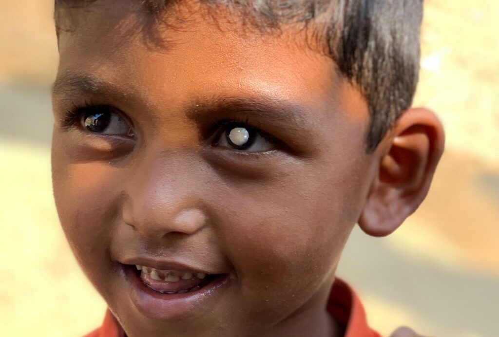 Boy with Cataract